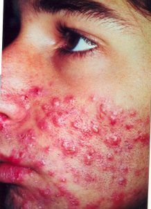 Derma Estetic tratamiento de acne en Quito